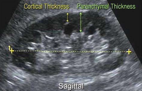 ultrasounds measure cortical thickness kidneys|cortical thickening kidney ultrasound.